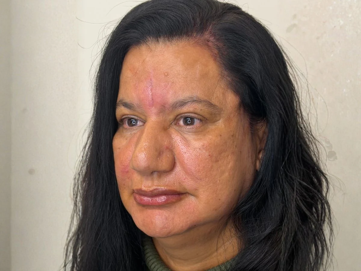 Depois Protocolo Elleve